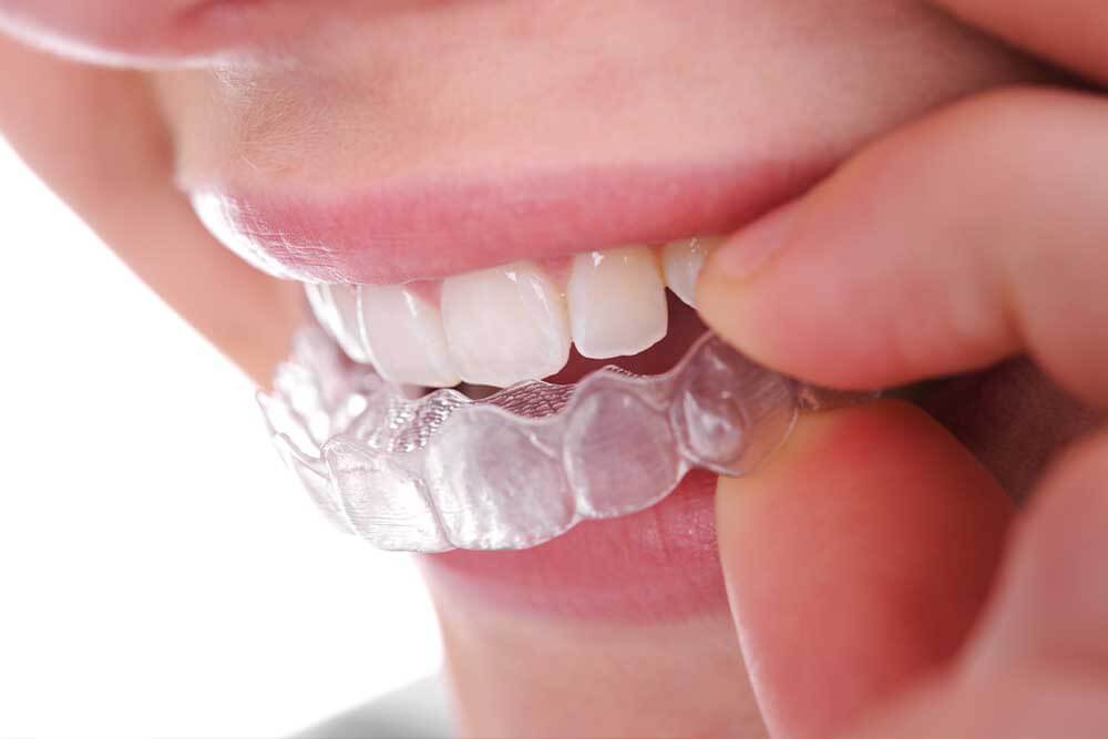 Invisalign Aligners Ripon | Clear Braces North Yorkshire | Boroughbridge Dental Practice