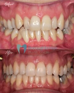 Clear Aligners